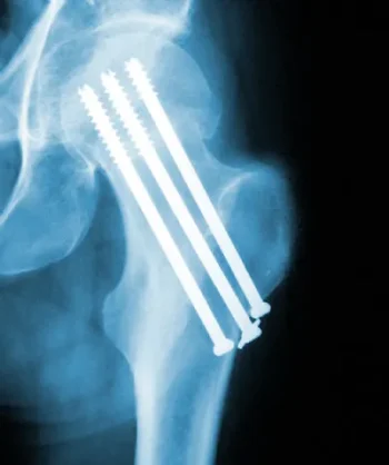 Cannulated-screws-Uses